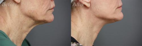 Face-Lift-LRS-before-and-after-patient-6a-dr-eric-a-cole