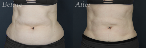 Liposuction-abdomen-flanks-56yrs-18416-2