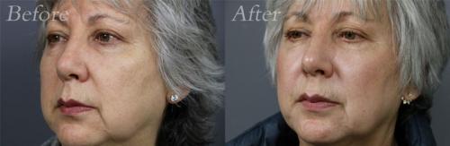 Sculptra-before-and-after-patient2b-dr-eric-a-cole