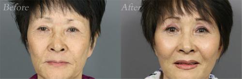 sculptra-before-and-after-patient1a-dr-eric-a-cole